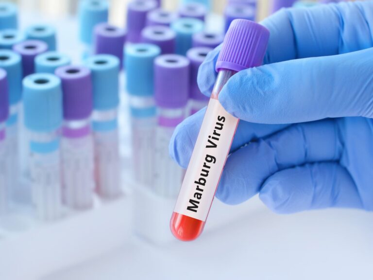 إثيوبيا-تعلن-تفشي-وباء-“ماربورغ”-جنوب-البلاد